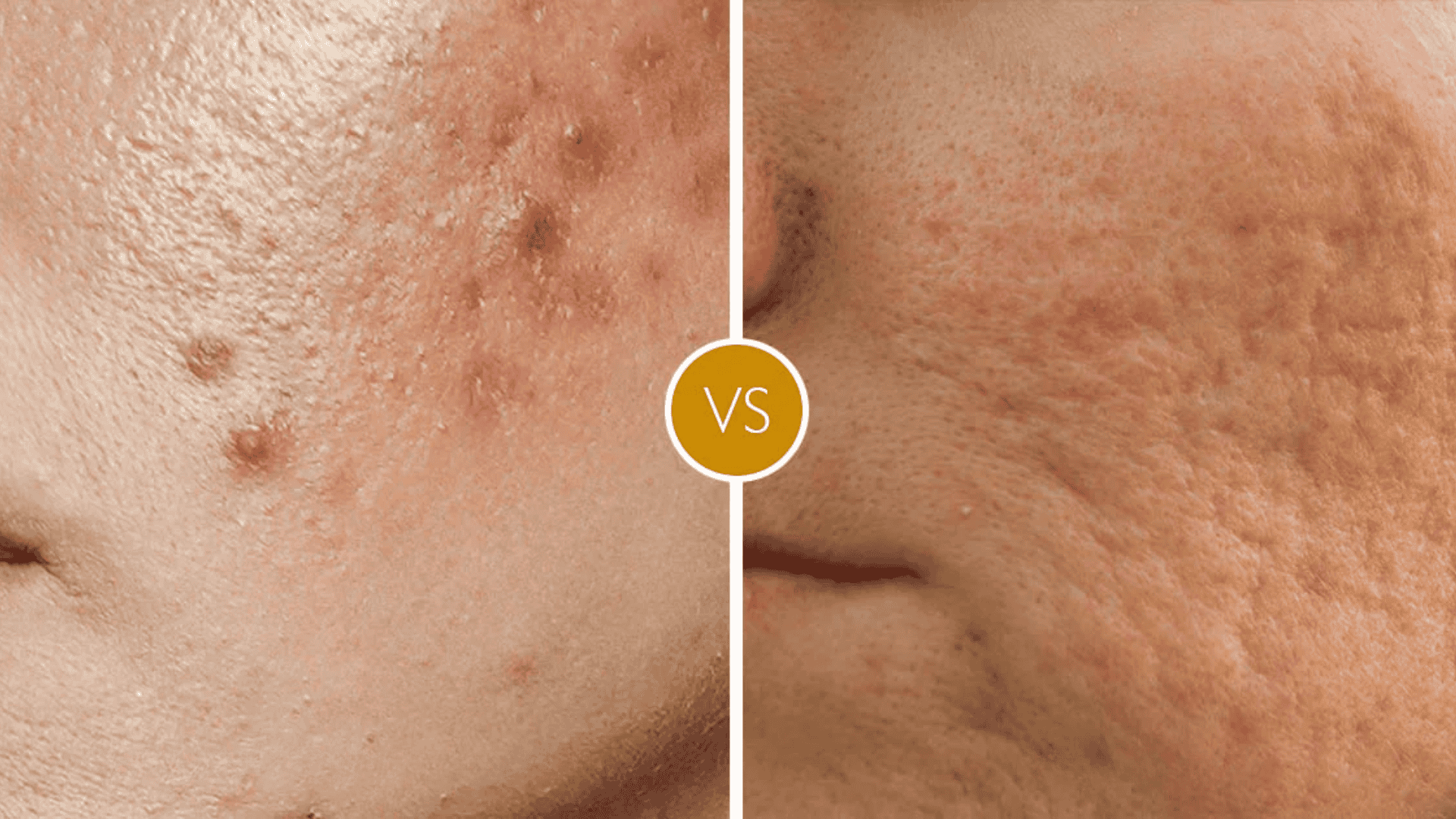 acne marks vs acne scars