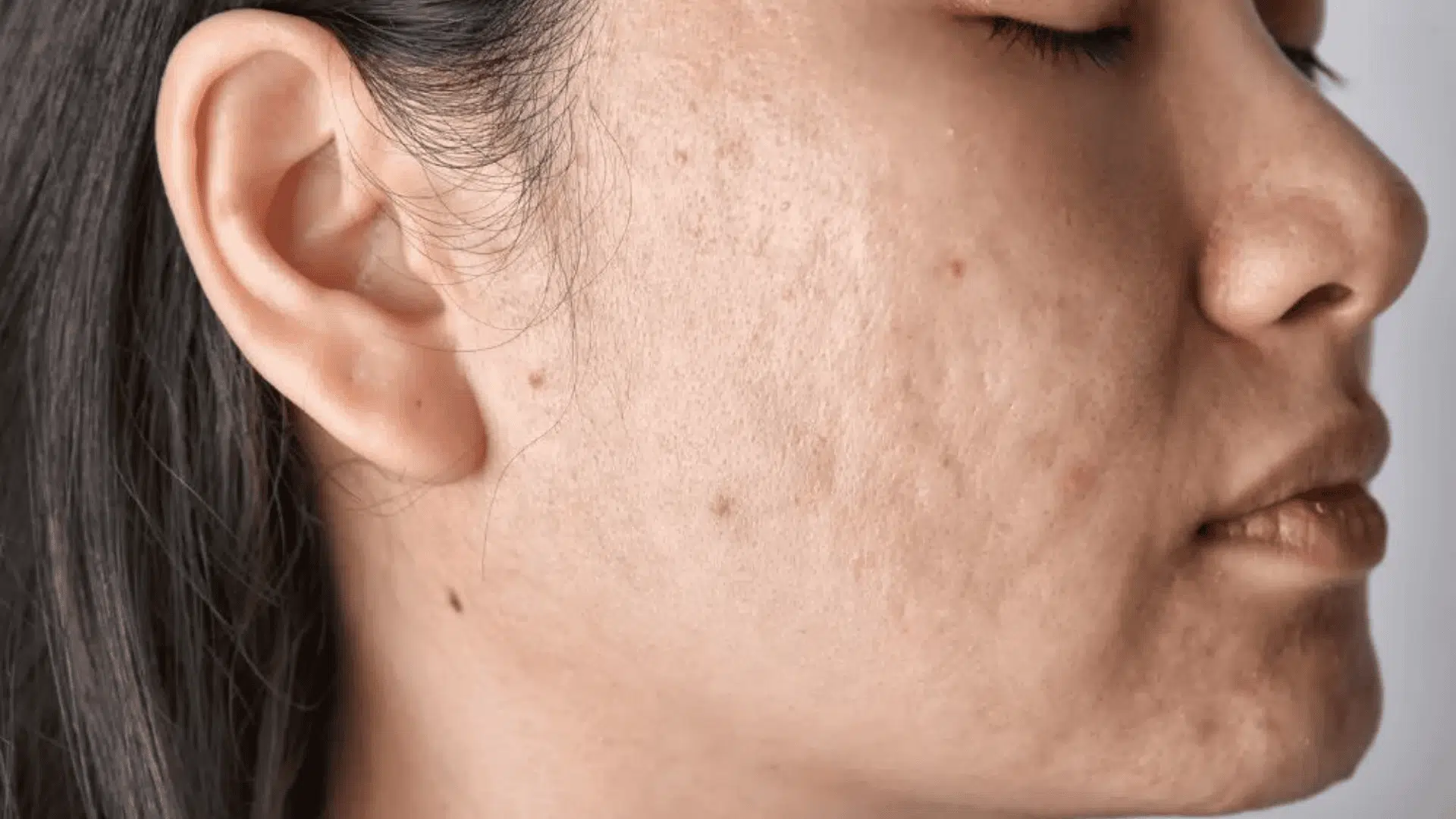 acne scars