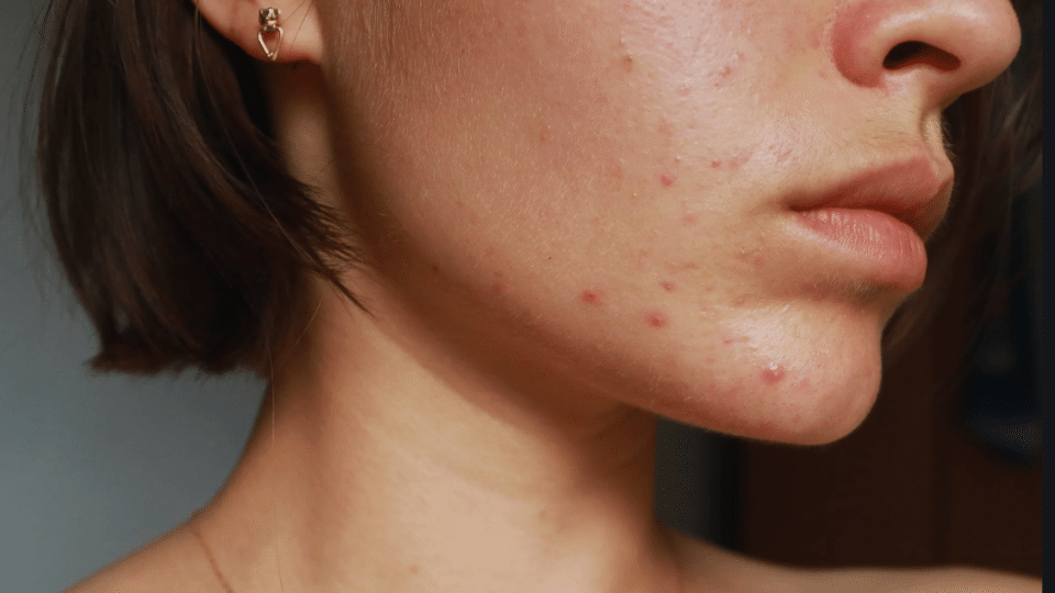 how to tell if acne is hormonal or bacterial