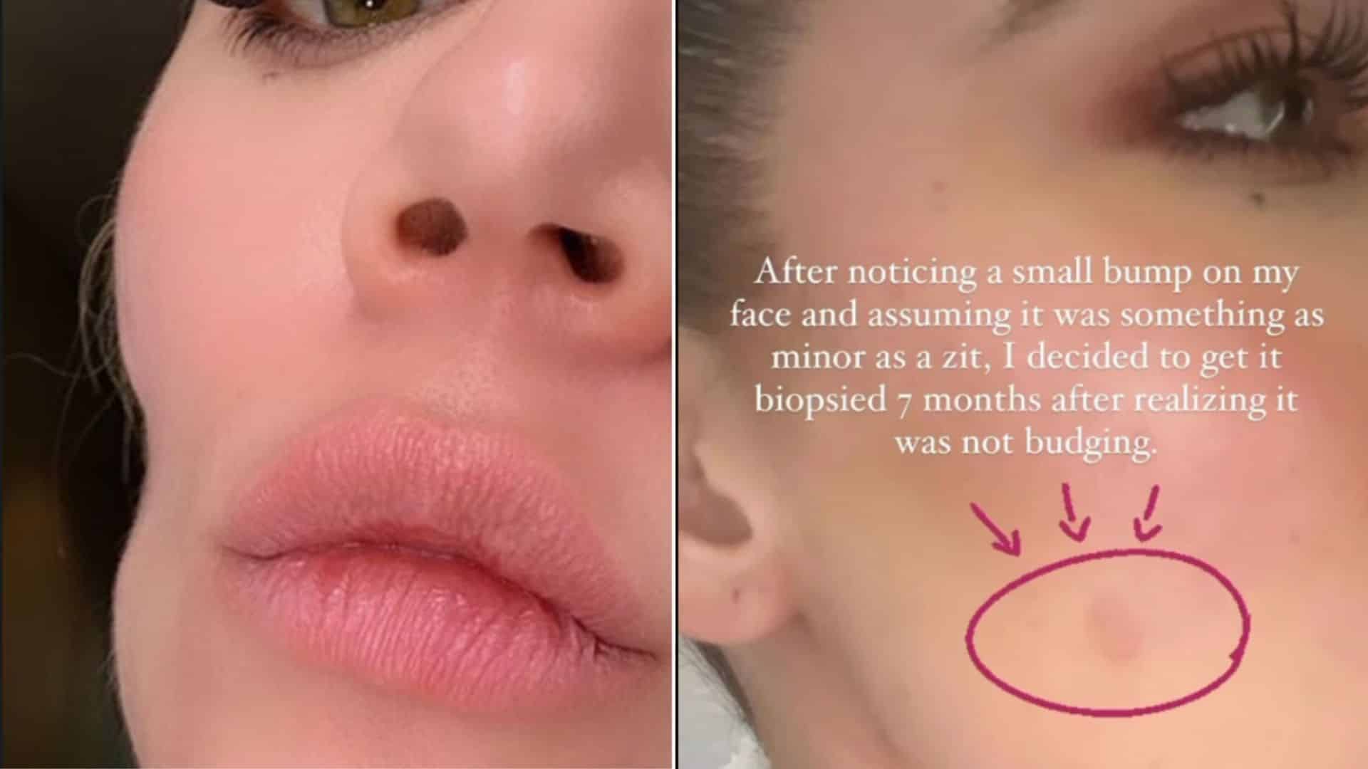 khloe kardashian cancer