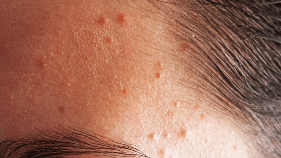 treat bacterial infected acne