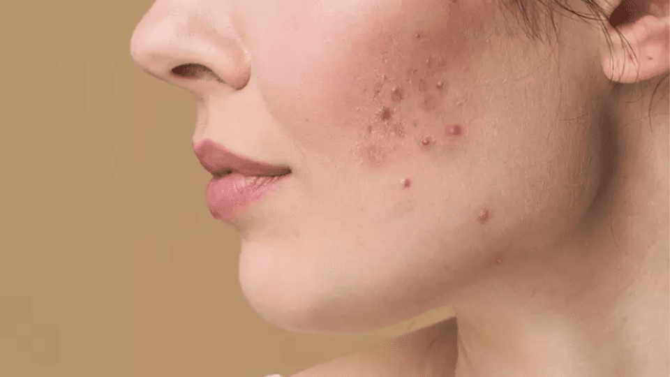 treat hormonal acne