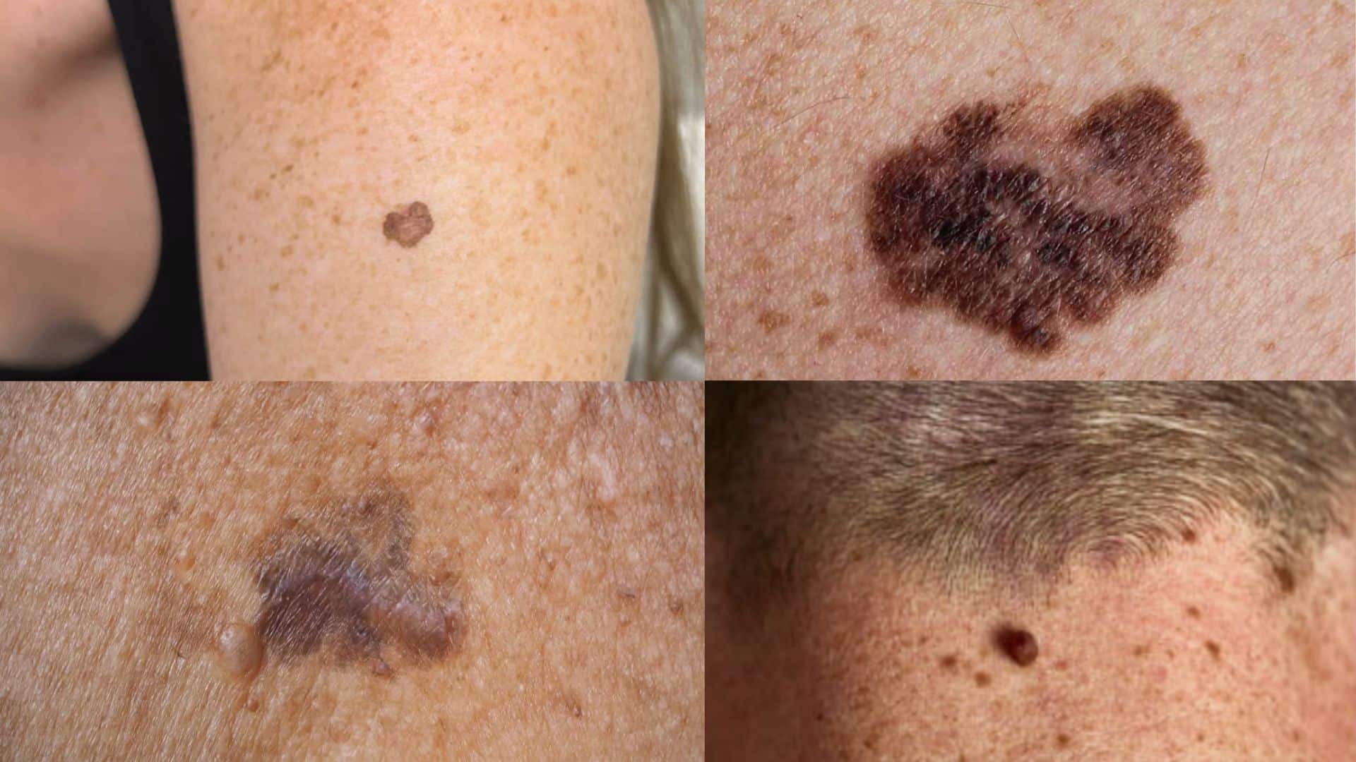 what is melanoma