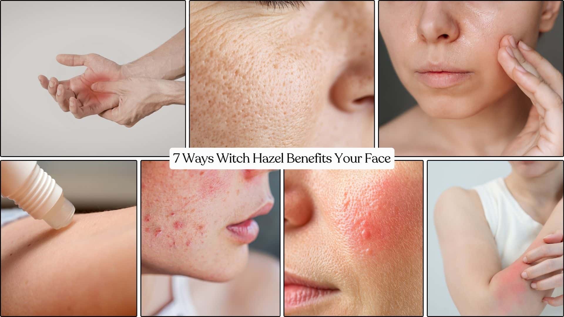 witch hazel benefits for skin