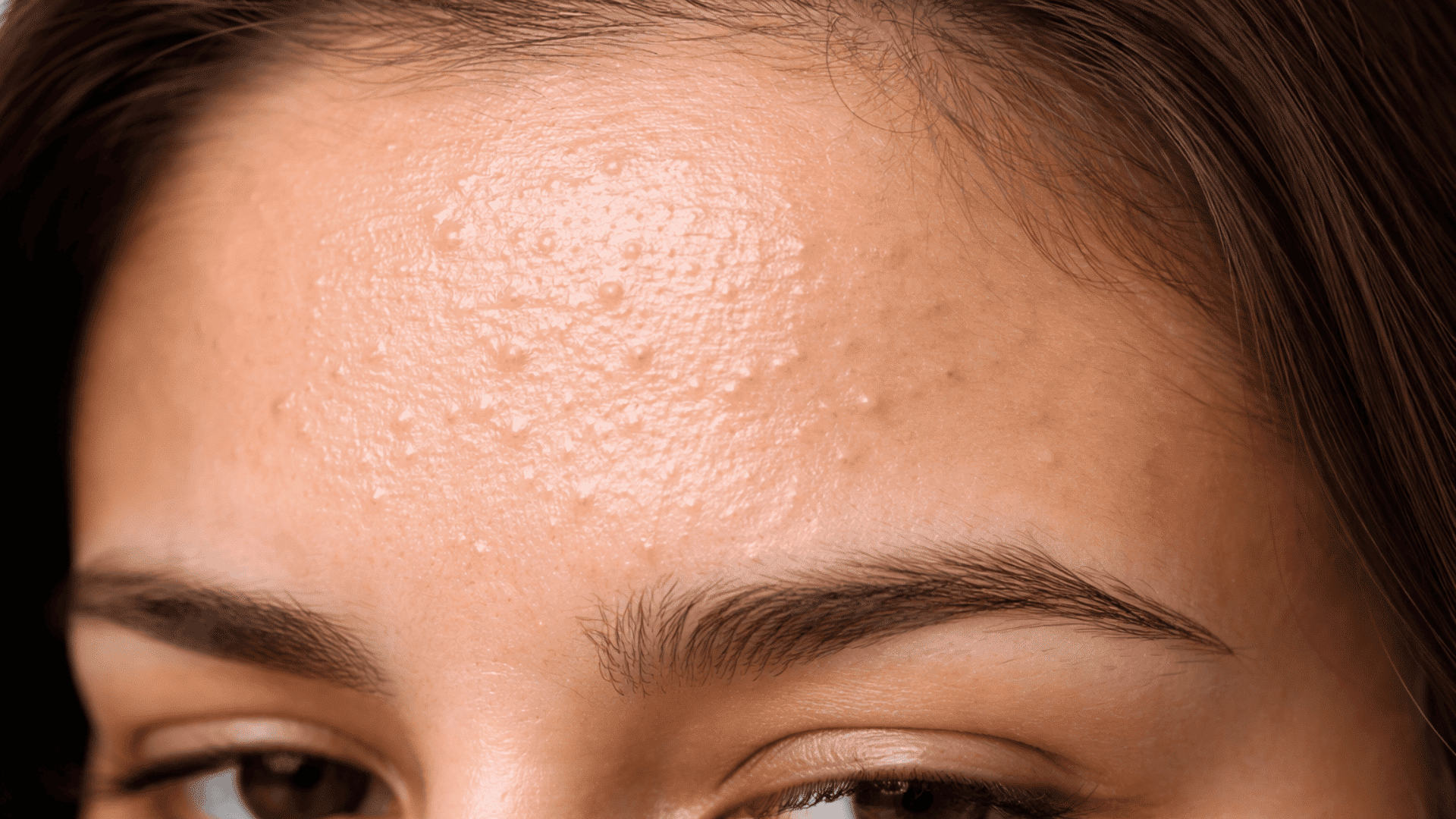 how to get rid of forehead bumps