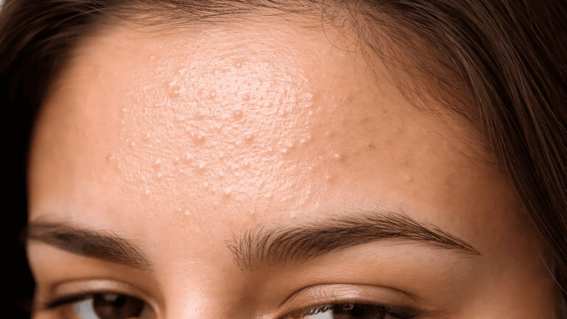 how to get rid of forehead bumps