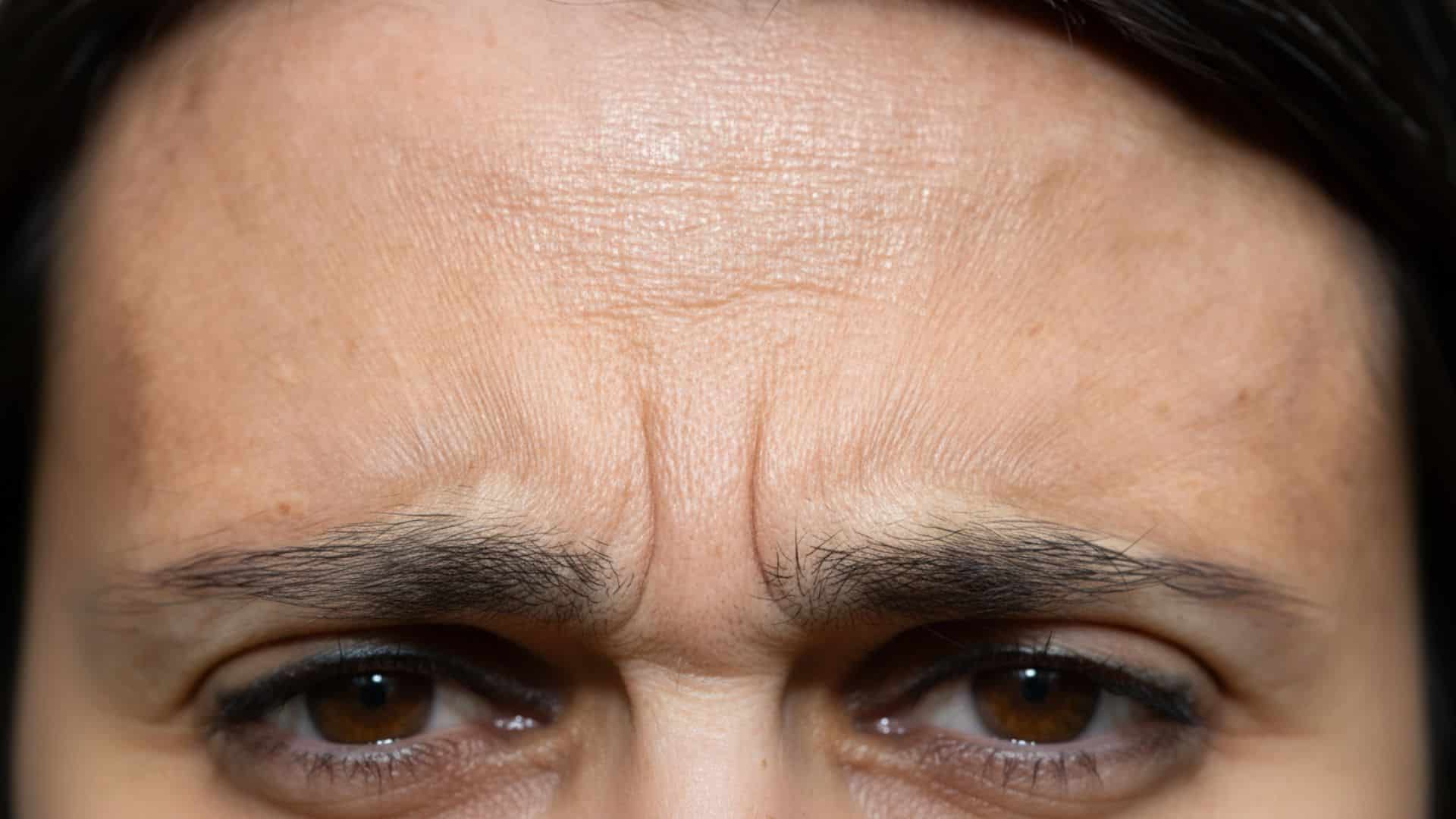 how to get rid of frown lines on forehead