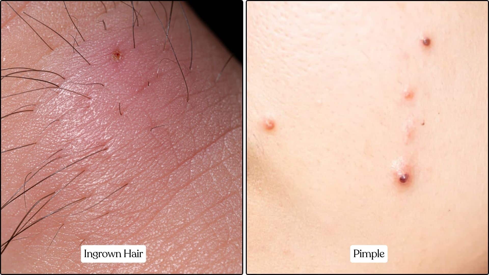 ingrown hair or pimple
