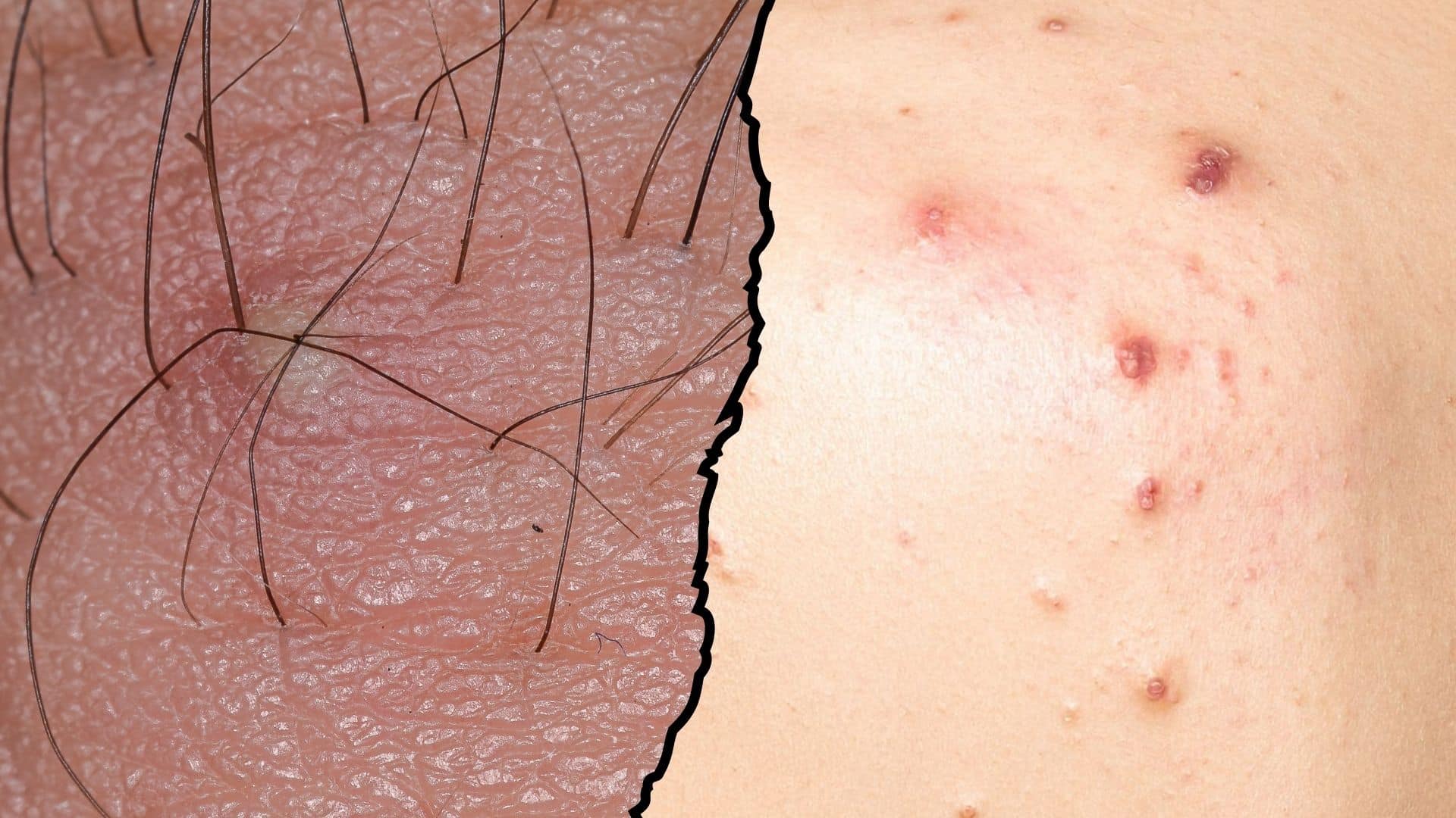 ingrown hair vs pimple how to tell