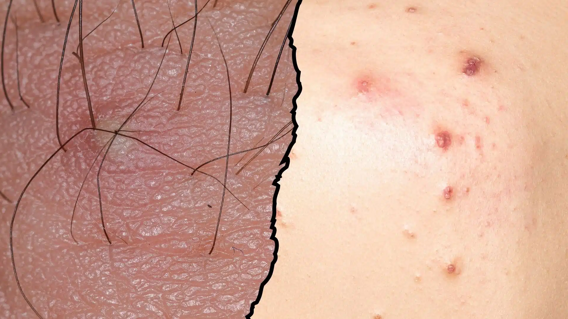 ingrown hair vs pimple how to tell