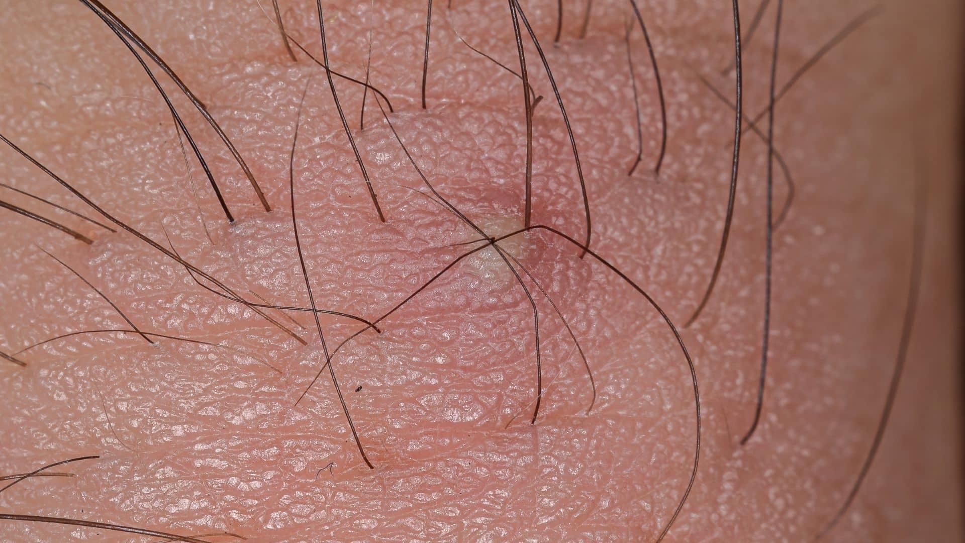 ingrown hair vs pimple images