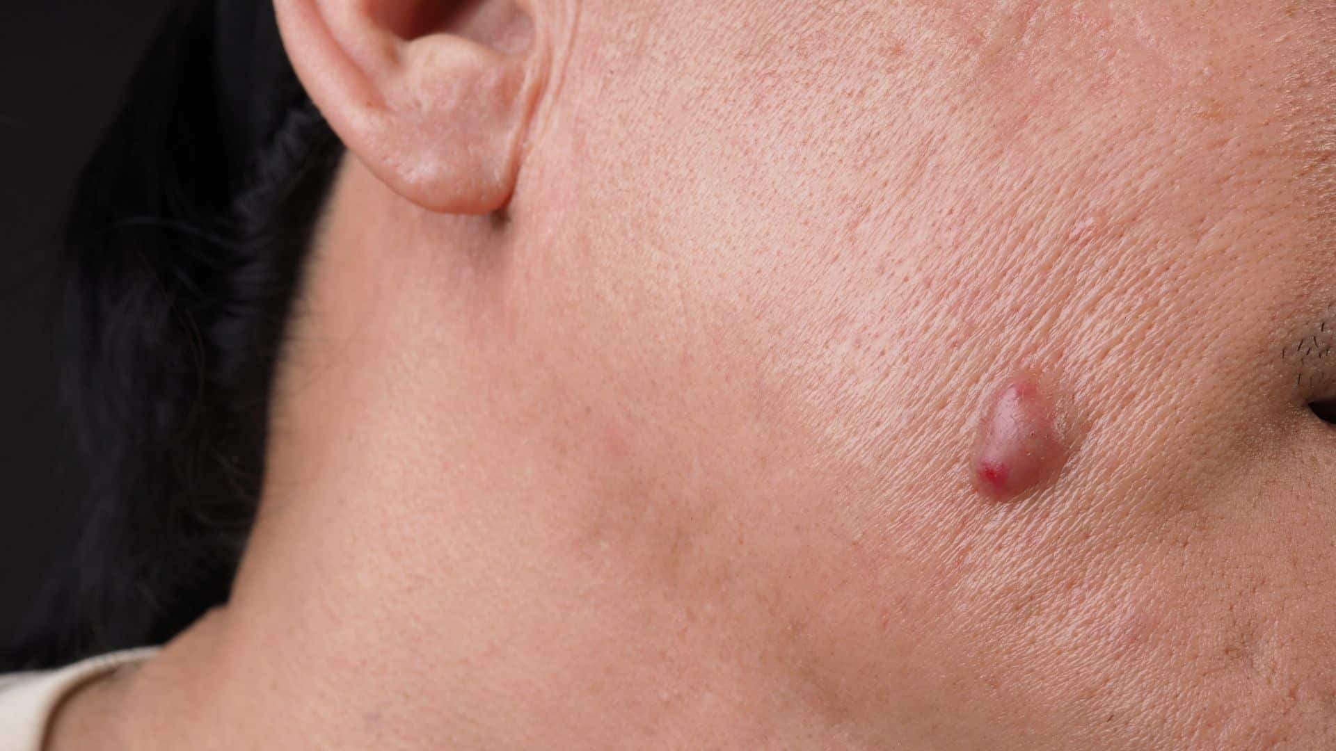 pimple vs cyst on face
