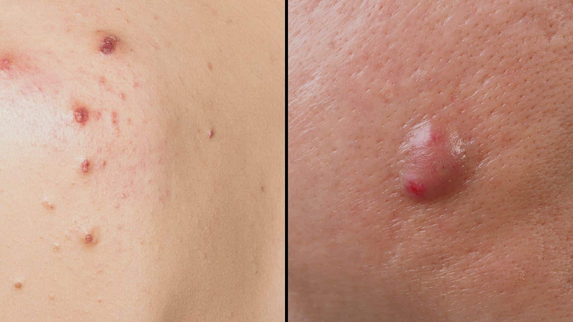 pimple vs cyst