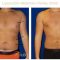 Get Your Body Back! Dr. Cruise Explains Liposuction for Men!