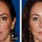 Turning Back the Clock! Dr. Joseph Cruise Explains Fat Transfer for Facial Rejuvenation!